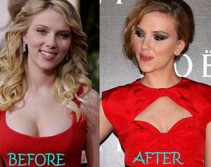 andre loi add photo scarlett johansson fake tits