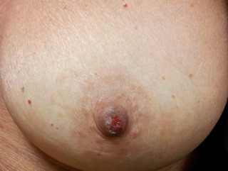 ana focsa recommends Abnormal Nipples Pics
