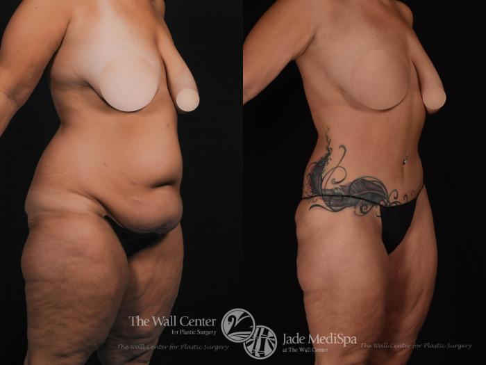 Best of Before and after nude weight loss