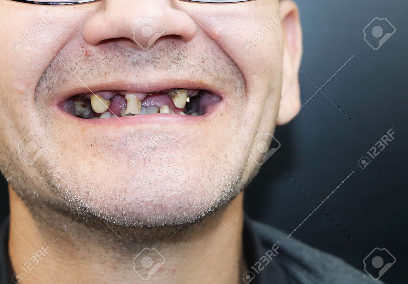 carmen hdez recommends black guy missing teeth pic