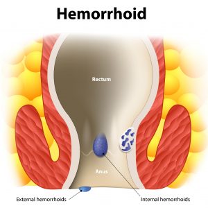 hemorrhoid pics tumblr