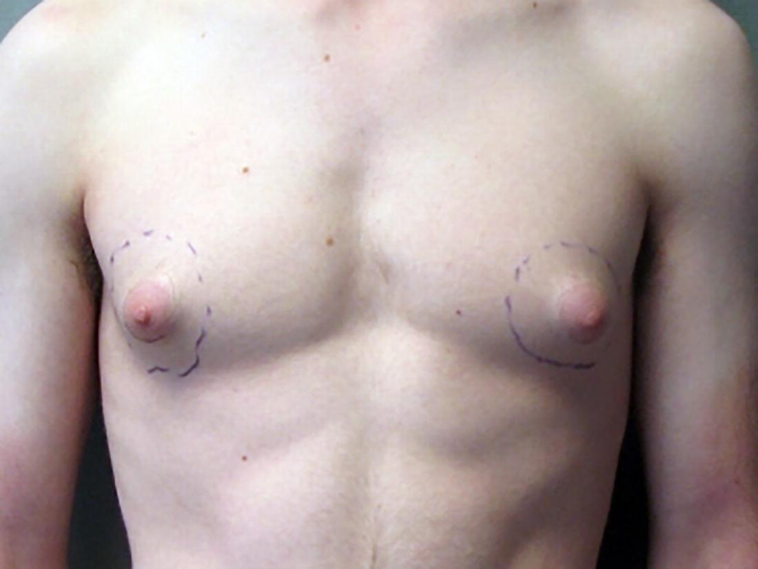 arvin cabanig recommends abnormal nipples pics pic