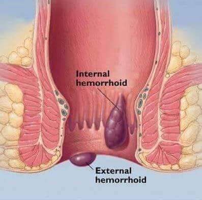 ahmer tariq recommends hemorrhoid pics tumblr pic