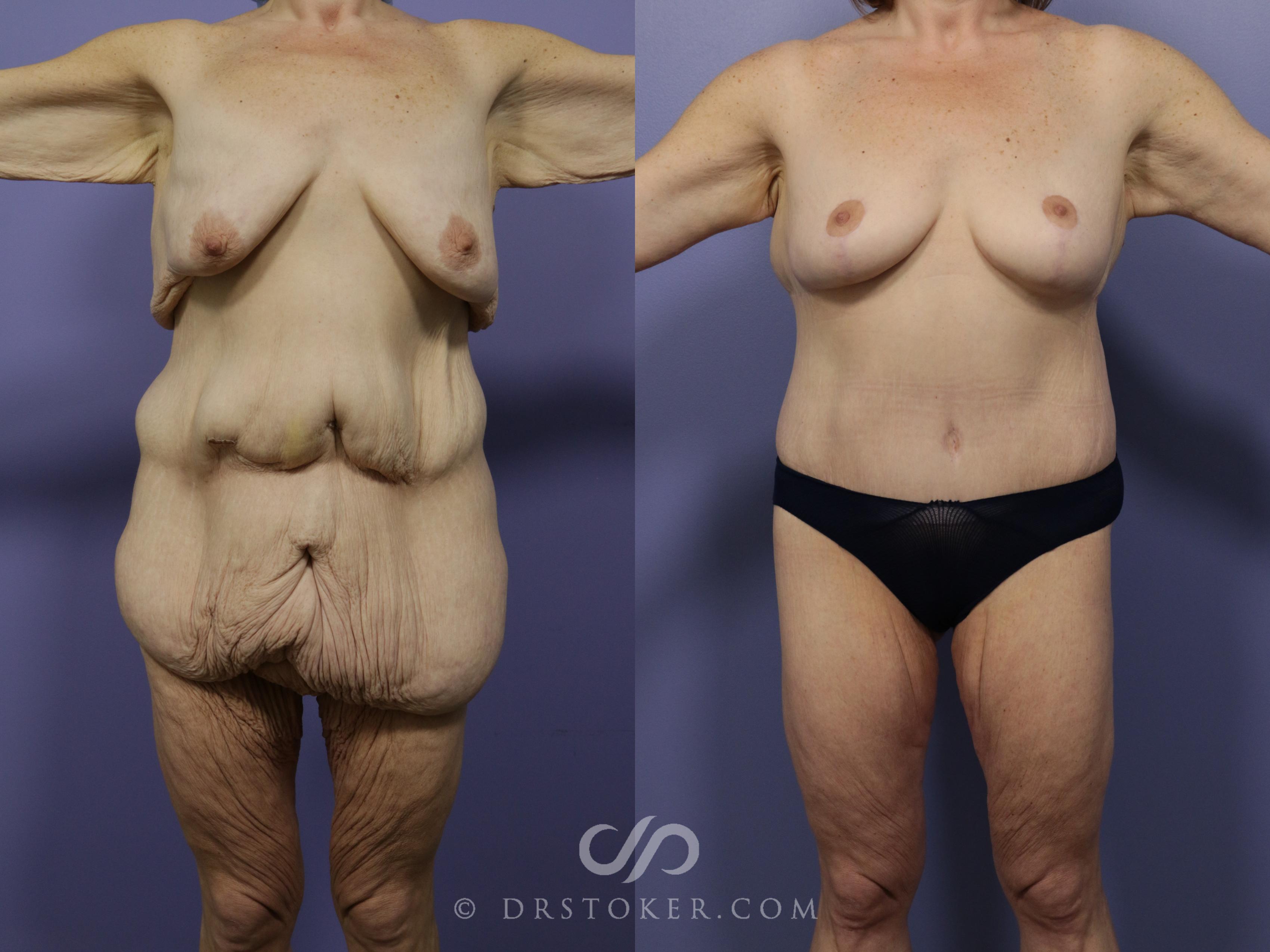 before and after nude weight loss