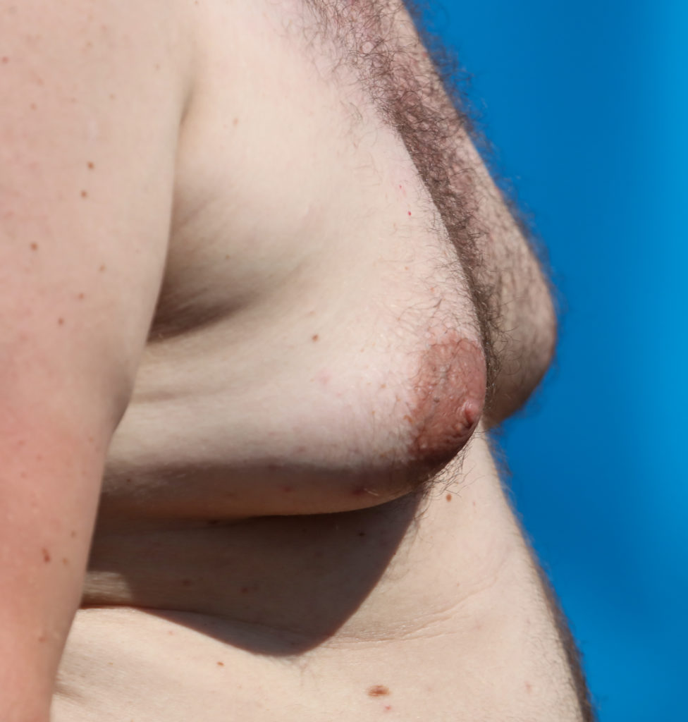 aureta craighead recommends fat nipples pics pic