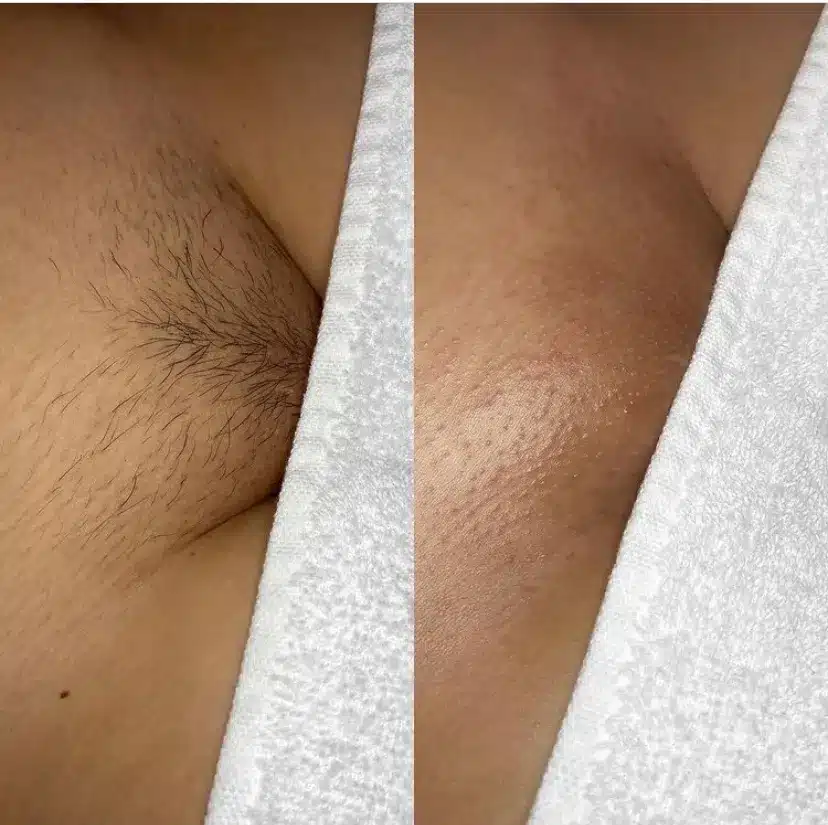 benny lam recommends brazilian waxing video graphic pic