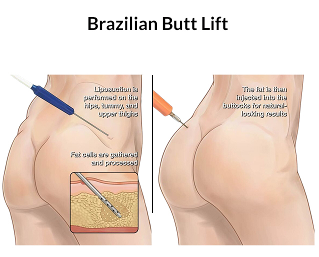 chase colby recommends Bubble Butts Brazilian