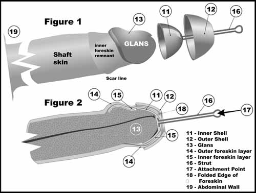 pictures of foreskin restoration