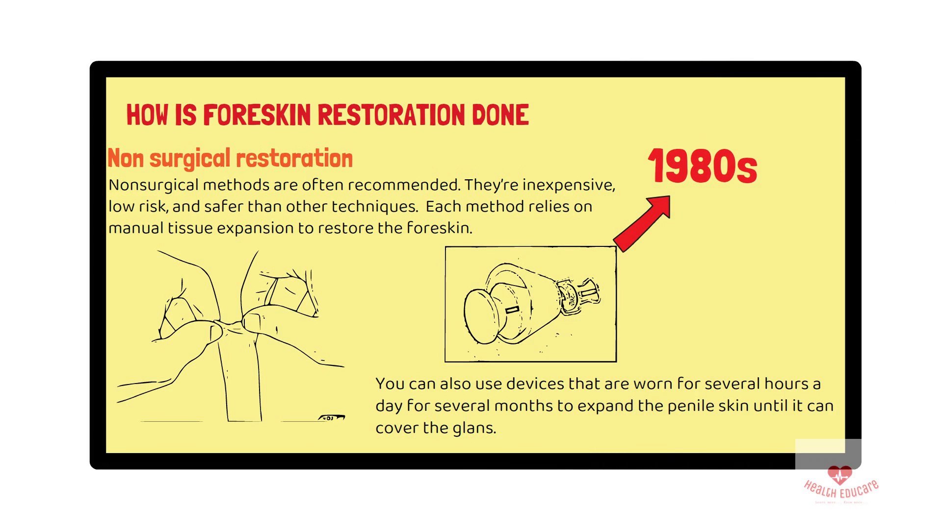 abdul moiz qureshi add photo pictures of foreskin restoration