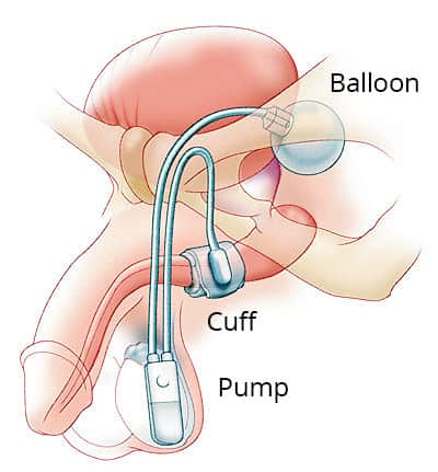 bhea bueno recommends Pumping Air Into Urethra