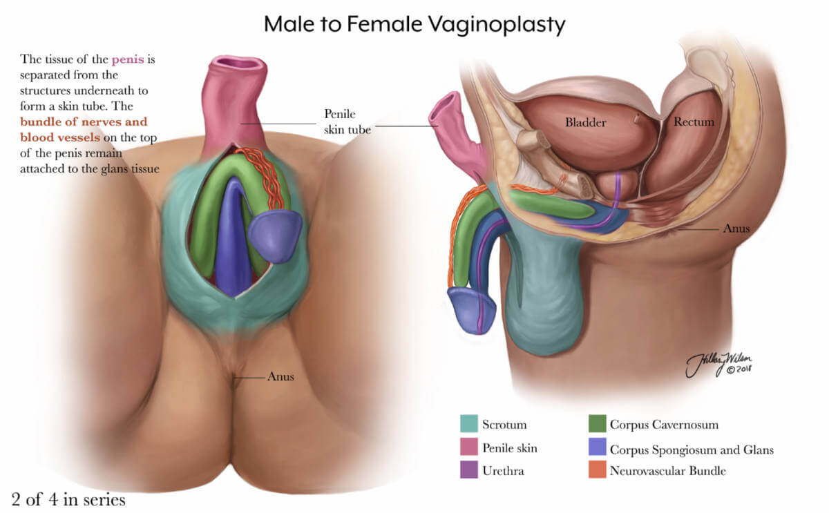 deneil watson recommends Turning Penis Into Vagina